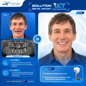 نتائج قبل وبعد زراعة الأسنان في مركز Lac Viet Intech Dental Center، ابتسامة مستعادة