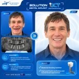 نتائج قبل وبعد زراعة الأسنان في مركز Lac Viet Intech Dental Center، ابتسامة مستعادة