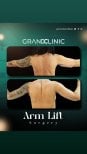 Résultats avant/après lifting des bras à Grand Clinic, contour du bras amélioré