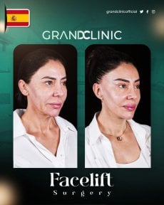 Résultats avant et après lifting du visage à Grand Clinic, rajeunissement visible