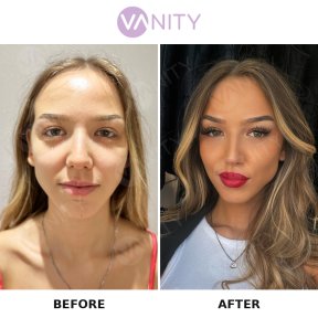 نتائج عملية تجميل الأنف قبل وبعد في Vanity Cosmetic Surgery Hospital، تحسين شكل الأنف
