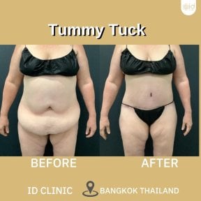 before-after photo abdominoplastika