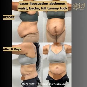 before-after photo abdominoplastika