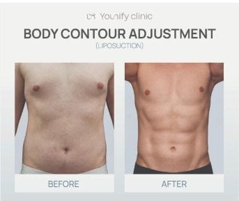 before-after photo abdominoplasty