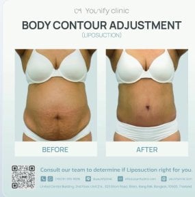 before-after photo abdominoplasty