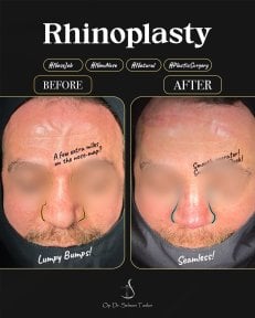Efekty przed i po rhinoplastyce w klinice dr Selmana Taskina, gładszy nos
