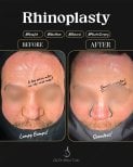 Efekty przed i po rhinoplastyce w klinice dr Selmana Taskina, gładszy nos