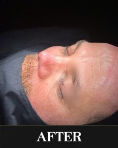 Efekt po rhinoplastyce u mężczyzny, widoczna poprawa kształtu i konturu nosa