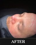 Efekt po rhinoplastyce u mężczyzny, widoczna poprawa kształtu i konturu nosa