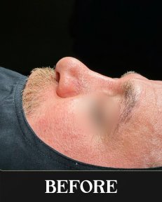 Pacjent mężczyzna przed rhinoplastyką, kształt nosa przed zabiegiem