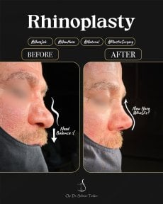 Efekt przed i po rhinoplastyce u dr Selmana Taskina, poprawiony kształt nosa