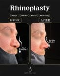 Efekt przed i po rhinoplastyce u dr Selmana Taskina, poprawiony kształt nosa