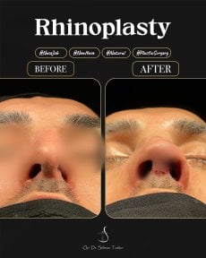 Efekty przed i po rhinoplastyce w klinice Dr. Selman Taskin, widoczna korekta nosa