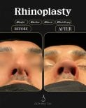 Efekty przed i po rhinoplastyce w klinice Dr. Selman Taskin, widoczna korekta nosa