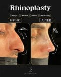 Efekty przed i po rhinoplastyce, poprawa profilu nosa u Dr. Selman Taskin