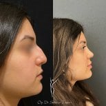 Efekty przed i po rhinoplastyce w klinice dr Selmana Taskina, poprawiony profil nosa