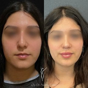 Efekty przed i po rhinoplastyce u dr Selmana Taskina, naturalny kształt nosa