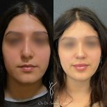 Efekty przed i po rhinoplastyce u dr Selmana Taskina, naturalny kształt nosa