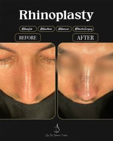 Efekty przed i po rhinoplastyce u dr Selmana Taskina, naturalny kształt nosa
