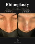 Efekty przed i po rhinoplastyce u dr Selmana Taskina, naturalny kształt nosa
