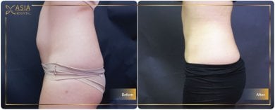 before-after photo breast-augmentation-with-fat-transfer