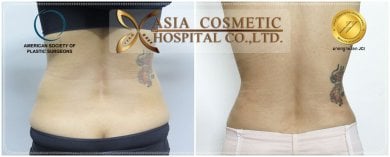before-after photo breast-augmentation-with-fat-transfer