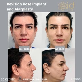 Before and after revision nose implant and alarplasty results at ID Clinic Bangkok