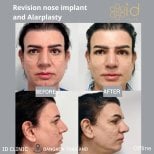 Before and after revision nose implant and alarplasty results at ID Clinic Bangkok