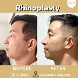 Before and after rhinoplasty results at ID Clinic Bangkok, improved nose profile in male patient