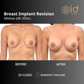 Before and after breast implant revision with Motiva 350cc at ID Clinic Bangkok results