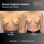 Before and after breast implant revision with Motiva 355cc at ID Clinic Bangkok results