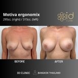 Before and after breast augmentation with Motiva implants at ID Clinic Bangkok, visible results