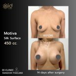 Before and after breast augmentation with Motiva 450cc at ID Clinic Bangkok, 14 days result