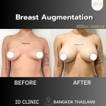 Before and after breast augmentation results at ID Clinic Bangkok with 400cc Motiva implants