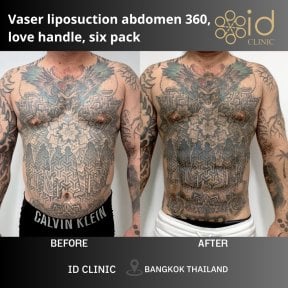 Before and after Vaser abdominal etching results at ID Clinic Bangkok for six pack abs