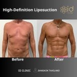 Before and after abdominal etching (six pack abs) result at ID Clinic Bangkok