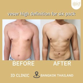 Before and after abdominal etching at ID Clinic Bangkok, six pack abs visible result