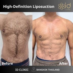 Before and after abdominal etching results at ID Clinic Bangkok, visible six pack abs contour
