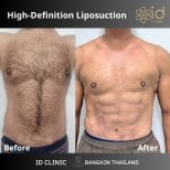 Before and after abdominal etching results at ID Clinic Bangkok, visible six pack abs contour