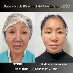 Before and after facelift and neck lift with SMAS technique at ID Clinic Bangkok, visible results