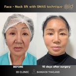 Before and after facelift and neck lift with SMAS technique at ID Clinic Bangkok, visible results