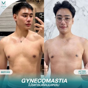 نتائج قبل وبعد جراحة التثدي في Munare Clinic Chiangmai، صدر أكثر تسطحًا