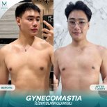 نتائج قبل وبعد جراحة التثدي في Munare Clinic Chiangmai، صدر أكثر تسطحًا