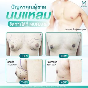 نتائج قبل وبعد جراحة التثدي في عيادة Munare Chiangmai، صدر مسطح