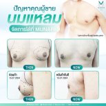 نتائج قبل وبعد جراحة التثدي في عيادة Munare Chiangmai، صدر مسطح