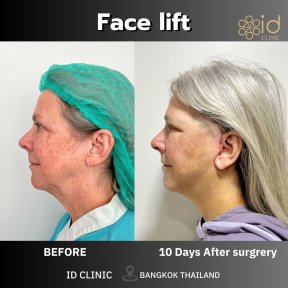 Facelift before and after results at ID Clinic Bangkok, visible facial rejuvenation in 10 days