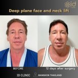 Before and after deep plane facelift and neck lift results at ID Clinic Bangkok, 12 days post-op