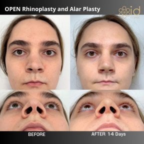 before-after photo tip-rhinoplasty