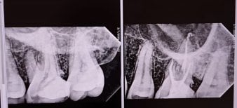 نتائج أشعة قبل وبعد علاج الجذور في عيادة Punta Cana dentist odontologia familiar