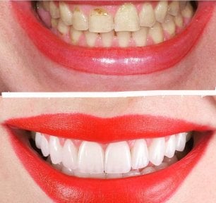 before-after photo smile-makeover